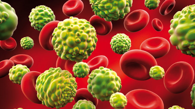 Ο δυτικός τρόπος διατροφής μπορεί να αυξήσει τον κίνδυνο θανάτου σε ασθενείς με καρκίνο του προστάτη